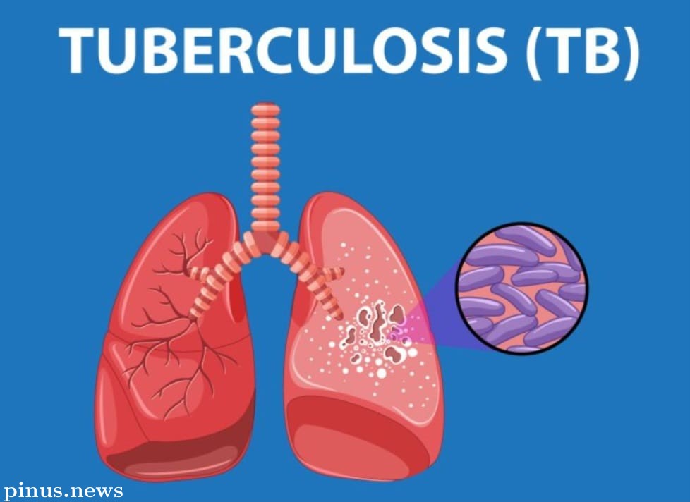 Kasus TBC Tinggi Karena Perbaikan Sistem Deteksi dan Pelaporan